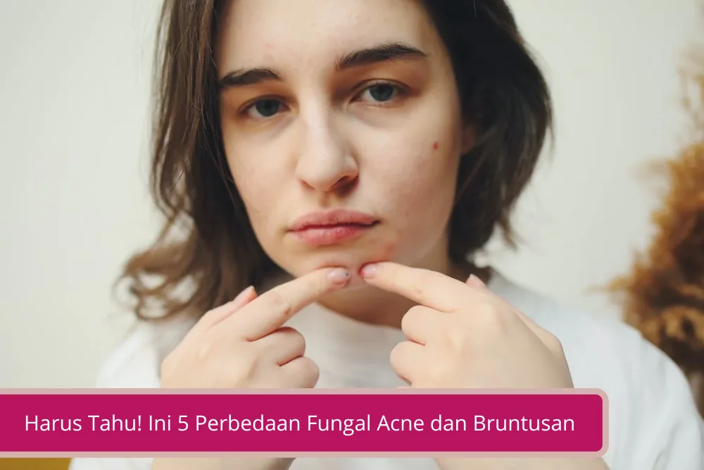Gambar Harus Tahu Ini 5 Perbedaan Fungal Acne dan Bruntusan