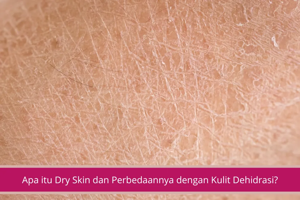 Gambar Apa itu Dry Skin dan Perbedaannya dengan Kulit Dehidrasi